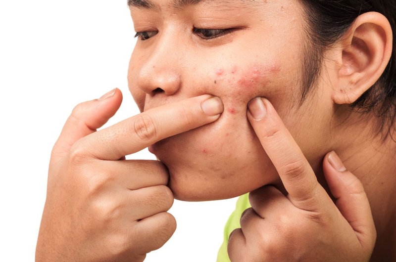 Loại mụn nào có thể nặn? Thế nào là cách nặn mụn đúng cách 1