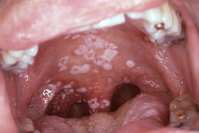 Cách ngăn ngừa nấm miệng khi niềng răng 1