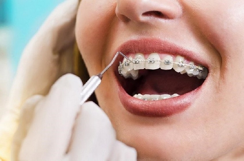 Cách ngăn ngừa nấm miệng khi niềng răng 2