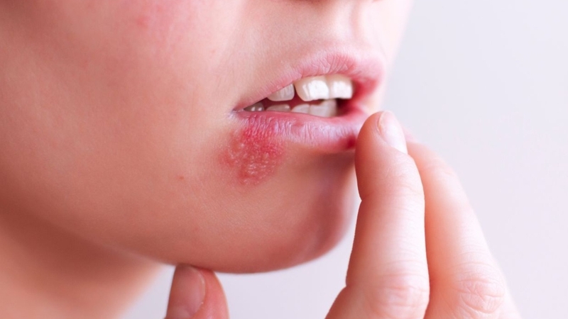 Cách nhận biết bệnh giời leo và kiến ba khoang cắn1