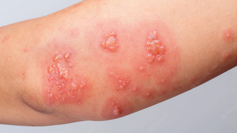 Cách nhận biết bệnh giời leo và kiến ba khoang cắn3