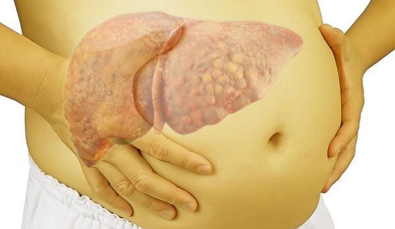 Cách nhận biết các dấu hiệu xơ gan từ sớm đơn giản và chính xác nhất 2