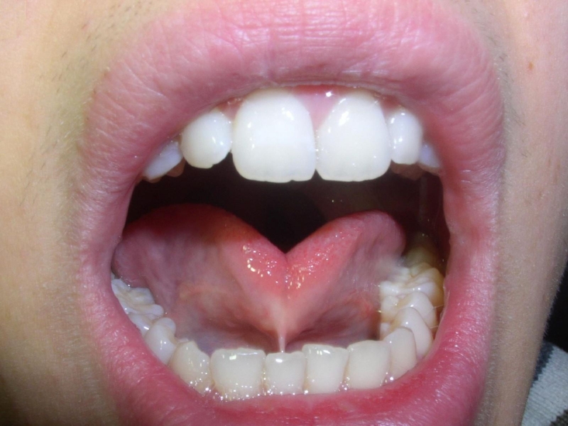 Cách nhận biết dính thắng lưỡi ở trẻ em1