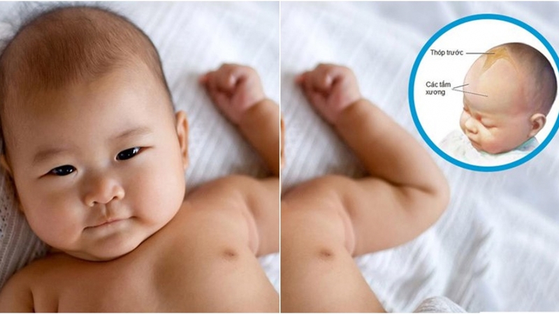 Cách nhận biết, phòng tránh và điều trị thóp trẻ sơ sinh bị lõm như thế nào? 2
