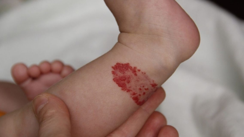 U máu nông thường có màu đỏ tươi và có thể phát triển nhanh trong những tháng đầu đời