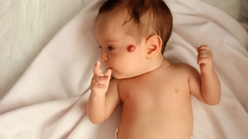 U máu ở trẻ sơ sinh có thể biểu hiện dưới dạng tổn thương nông hoặc khối nằm sâu dưới da