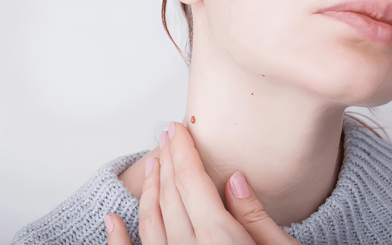 Cách nhận biết và điều trị mụn thịt ở cổ