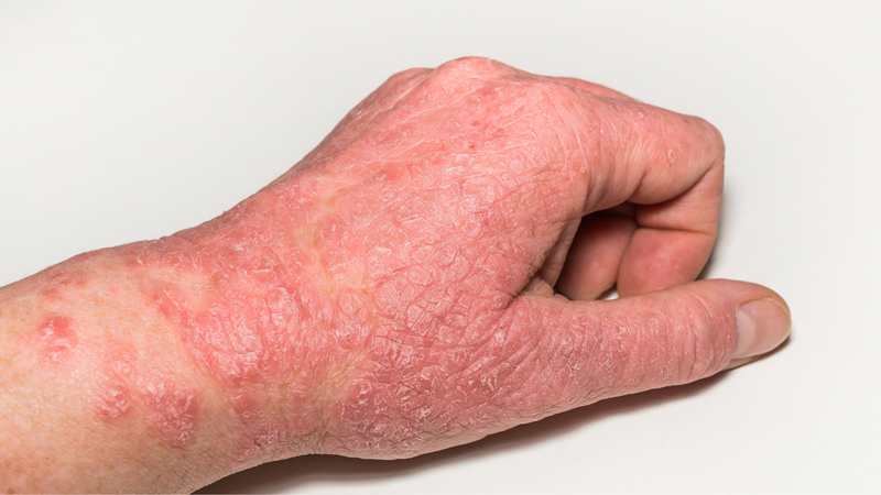 Cách nhận biết viêm da cơ địa bội nhiễm và cách điều trị 1