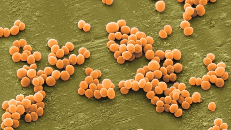 Cách nhận biết viêm da cơ địa bội nhiễm và cách điều trị 2