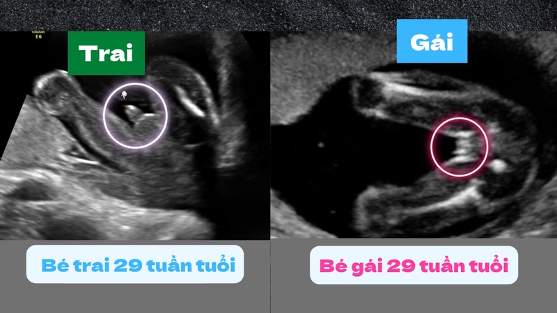 Cách nhìn hình siêu âm làm sao biết trai hay gái chính xác nhất 2