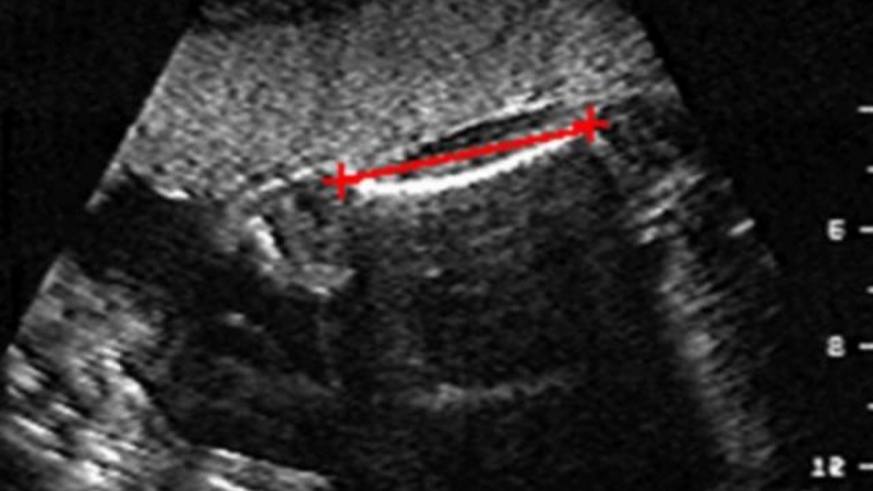 nhìn hình siêu âm làm sao biết trai hay gái