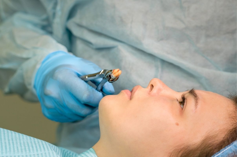 Cách nhổ răng hàm bị sâu tại nhà thế nào? Có an toàn không 4