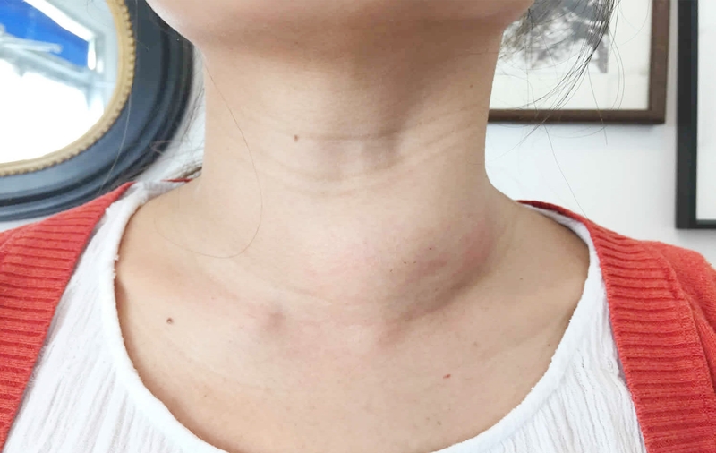 Cách phân biệt bệnh bướu cổ và bệnh bazơđô