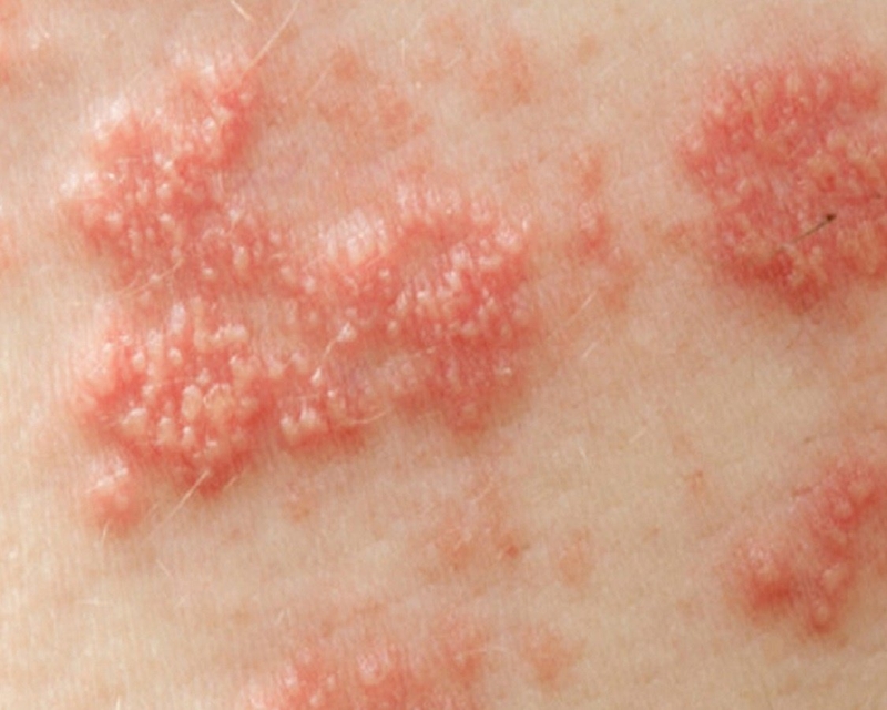 Cách phân biệt mụn cóc sinh dục và mụn rộp sinh dục 1