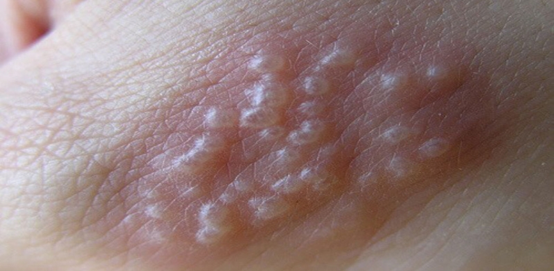 Cách phân biệt mụn cóc sinh dục và mụn rộp sinh dục 2