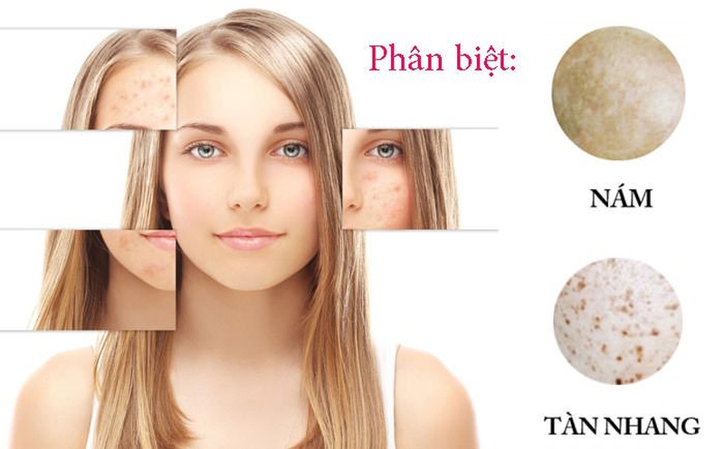 Cách phân biệt nám da, tàn nhang và sạm da 2