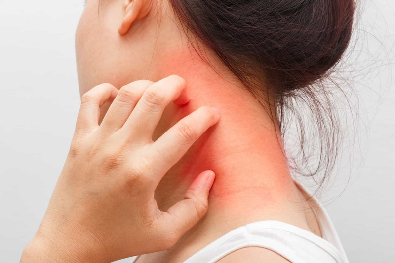 Cách phân biệt rôm và sởi 2