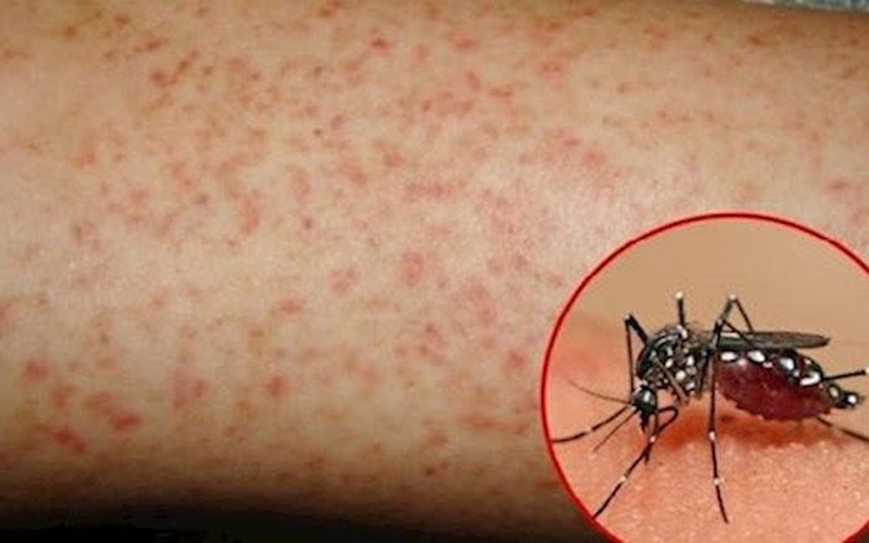 Cách phân biệt sự khác nhau của sốt phát ban và sốt xuất huyết