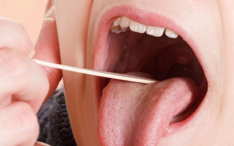 Cách phân biệt viêm họng hạt và sùi mào gà