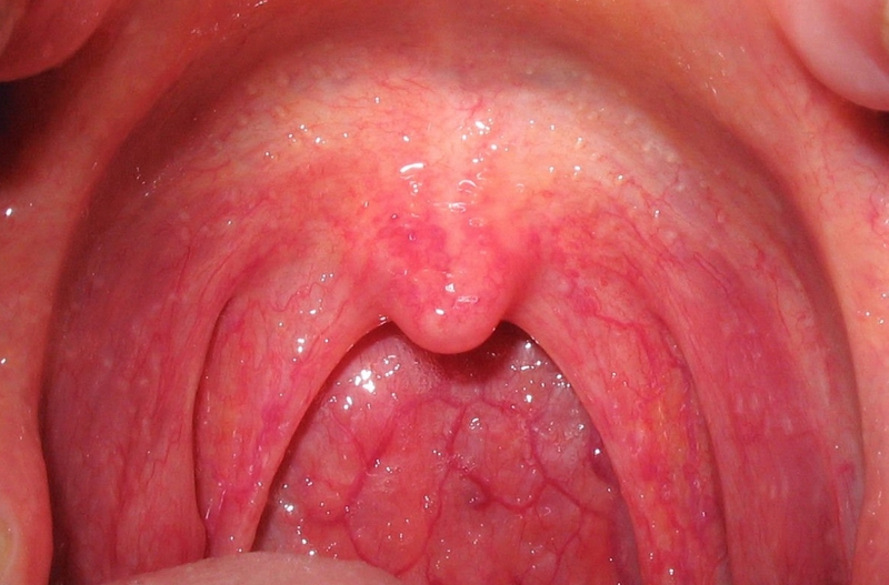 Cách phân biệt viêm họng hạt và sùi mào gà