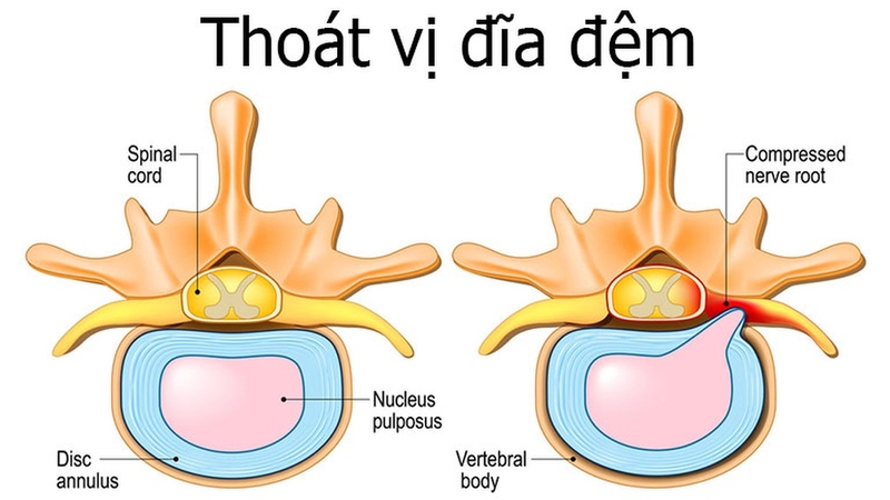 Cách phân loại thoát vị đĩa đệm: Các dạng thoát vị và cách điều trị 1
