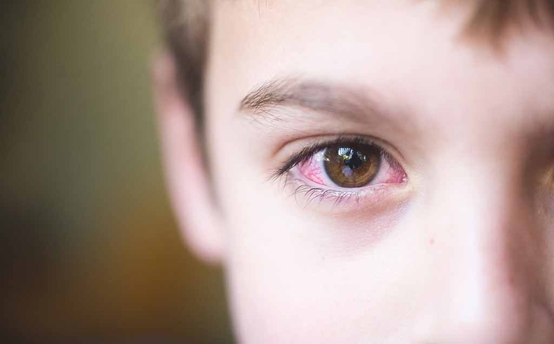 Cách phòng khô mắt do thiếu vitamin A cho trẻ mà bạn nên biết 3