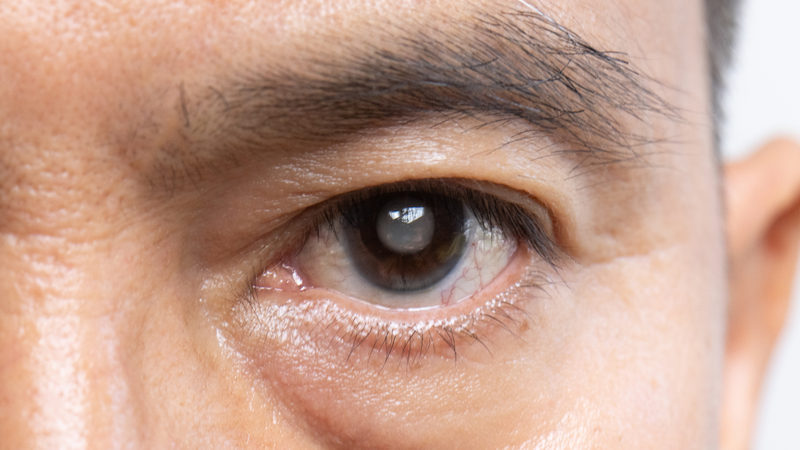 Cách phòng ngừa đục thủy tinh thể - Nguyên nhân dẫn đến tình trạng đục thủy tinh thể 1