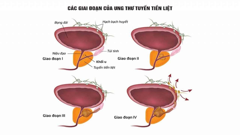 Cách phòng ngừa ung thư tuyến tiền liệt hiệu quả mà bạn không nên bỏ qua 1