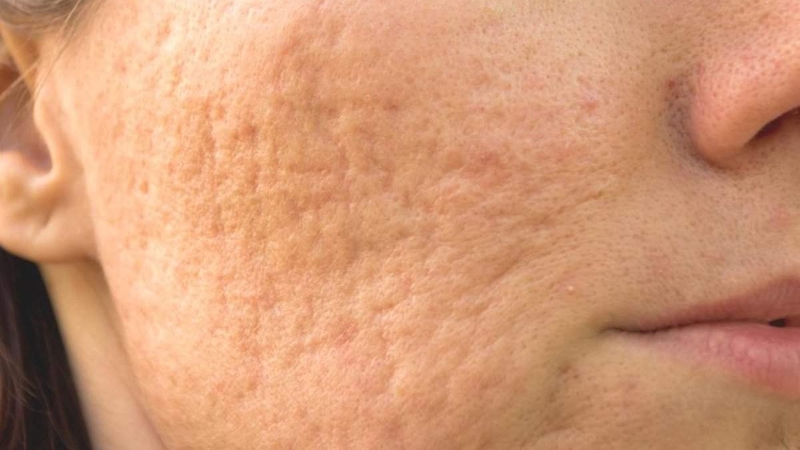 Có nhiều nguyên nhân gây ra sẹo rỗ trên mặt