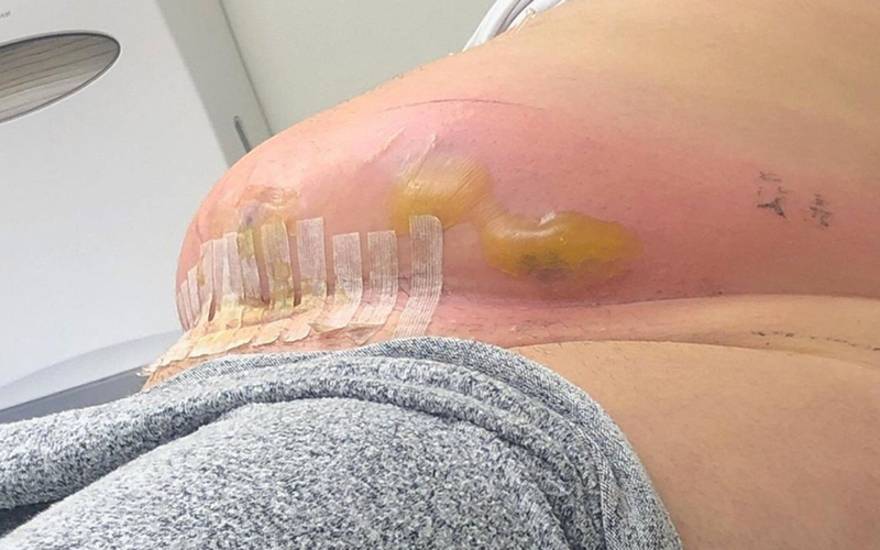 Cách rửa vết thương khâu tại nhà 1