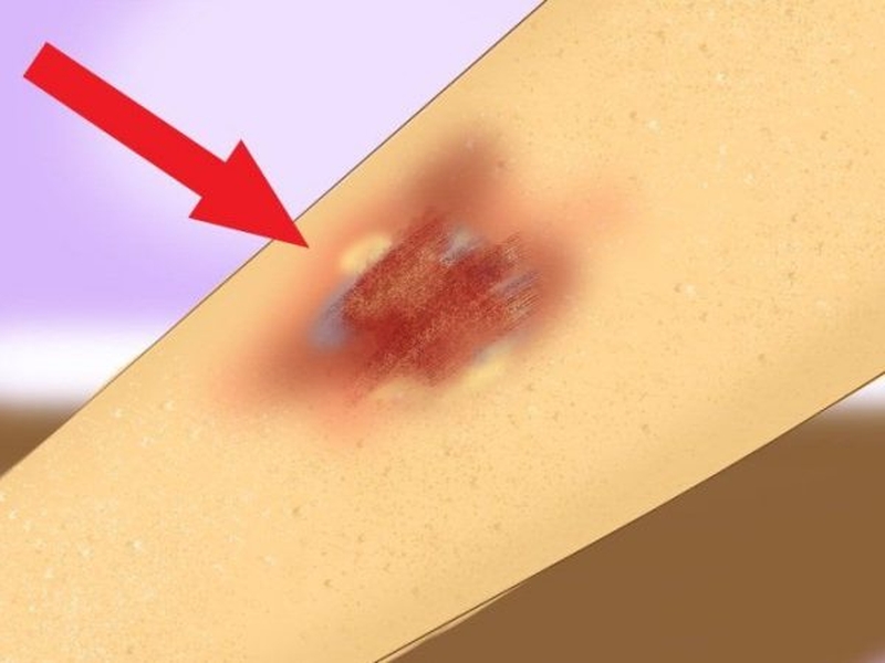 Cách rửa vết thương khâu tại nhà 2