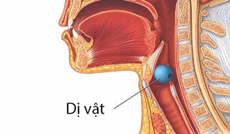 cach-cap-cuu-hoc-di-vat-hieu-qua-nhung-don-gian-co-the-ap-dung-trong-cuoc-song 1