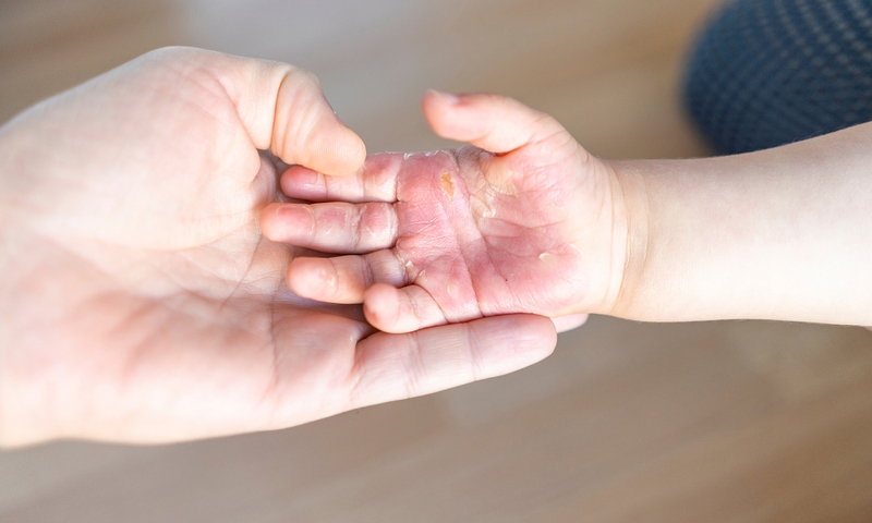 Cách sơ cứu bỏng nước sôi hiệu quả nhất 2