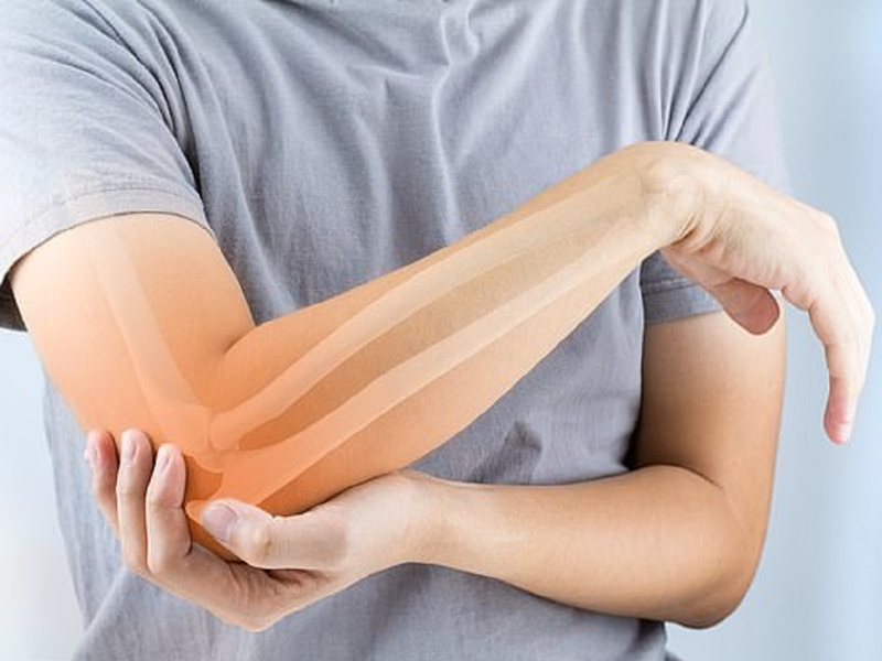 Cách sơ cứu gãy xương kín như thế nào? 1