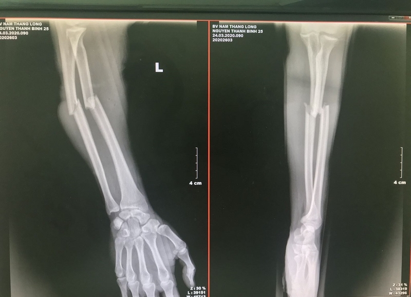 Cách sơ cứu gãy xương kín như thế nào?