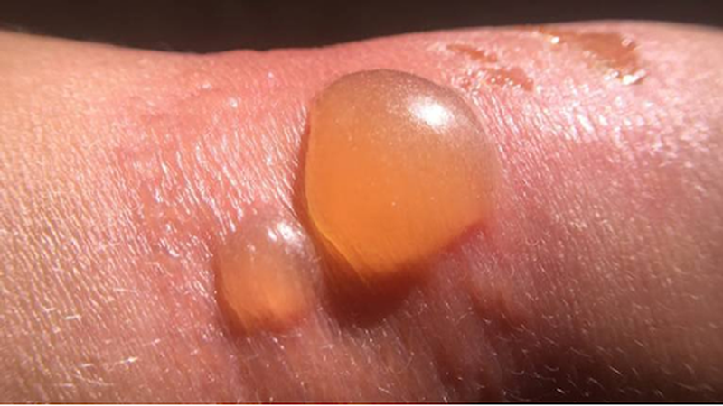 Cách sơ cứu khi bị bỏng da 1