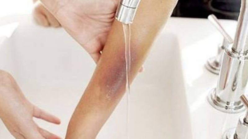 Cách sơ cứu khi bị bỏng da 2