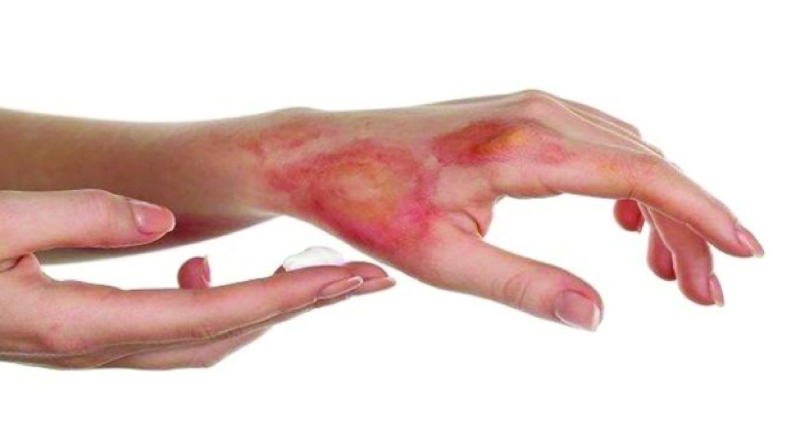 Trong hầu hết các trường hợp bỏng tay mức độ nhẹ, các biện pháp khắc phục tại nhà cũng có thể giảm đau và làm lành sẹo do bỏng