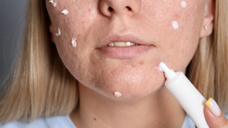 Không dùng kem trị nám Transino ban ngày trên vùng da đang tổn thương