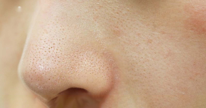 Da bị mụn cám do tác động tự bụi bẩn