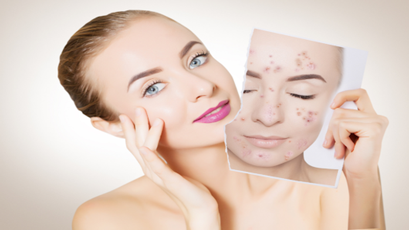 Cách sử dụng thuốc tránh thai trị mụn nội tiết 3