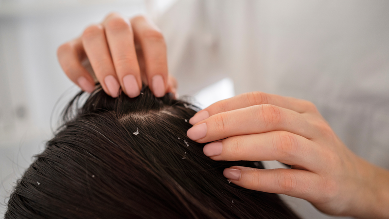 Không nên tự điều trị tại nhà khi nghi ngờ mắc bệnh lý da đầu