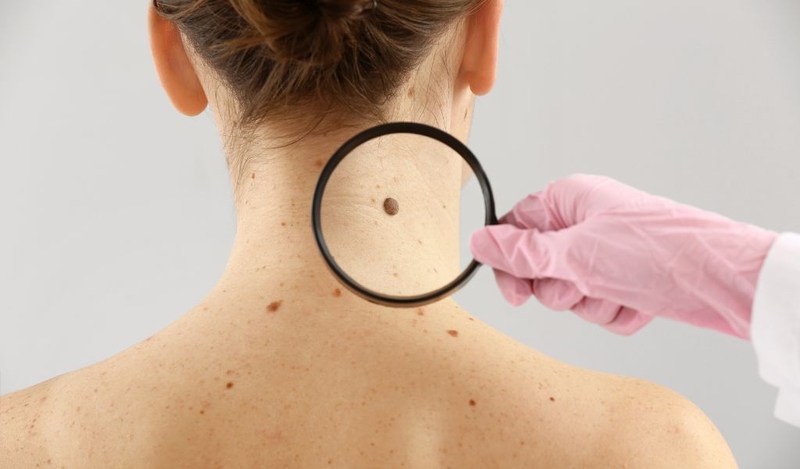 Cách tẩy nốt ruồi bằng kem đánh răng hiệu quả cho trường hợp nào? 1