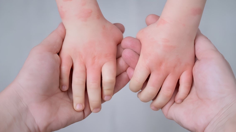 Cách thử sữa cho trẻ dị ứng đạm bò cần dựa trên mức độ dị ứng và nguy cơ phản ứng