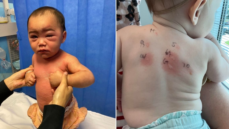 Trẻ có thể được đưa đạm sữa bò trở lại theo từng bước phù hợp