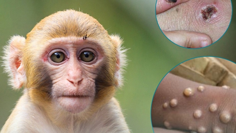 Cách trị bệnh đậu mùa khi trước những diễn biến khó lường 1