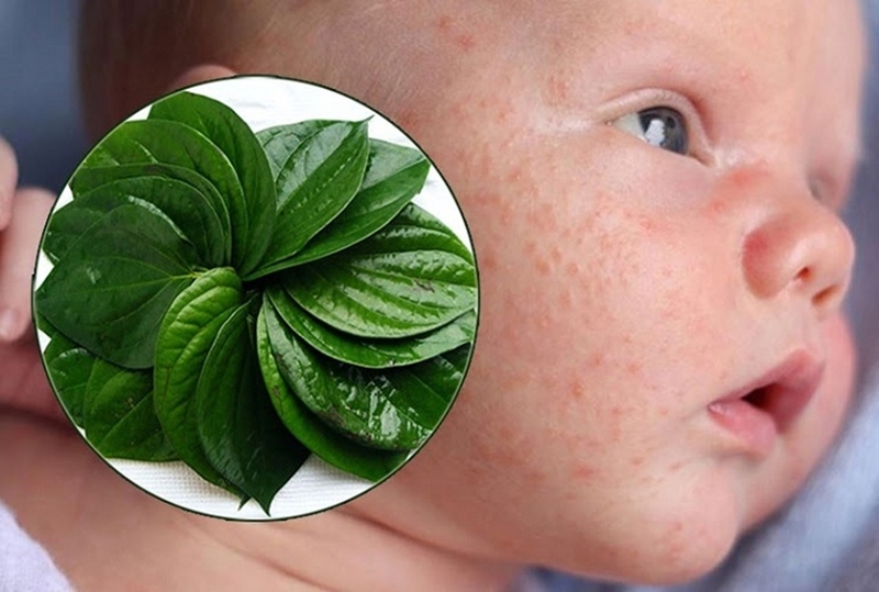 cách trị chàm sữa bằng lá trầu không 2