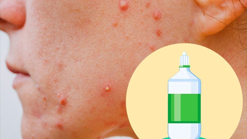 Cách trị dị ứng da mặt bằng nước muối hiệu quả 1