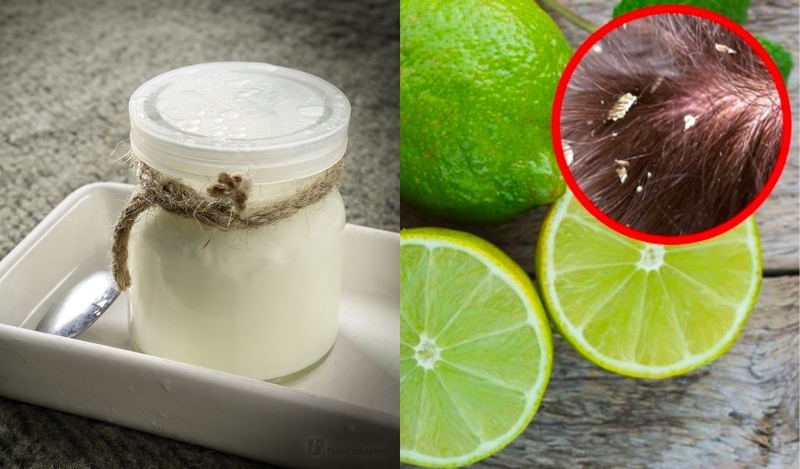 Cách trị gàu mùa đông hiệu quả và nguyên nhân gây nên hiện tượng này 2