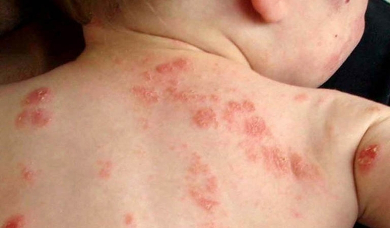 Cách trị giời leo ở trẻ em hiệu quả và an toàn mà mẹ cần biết 1